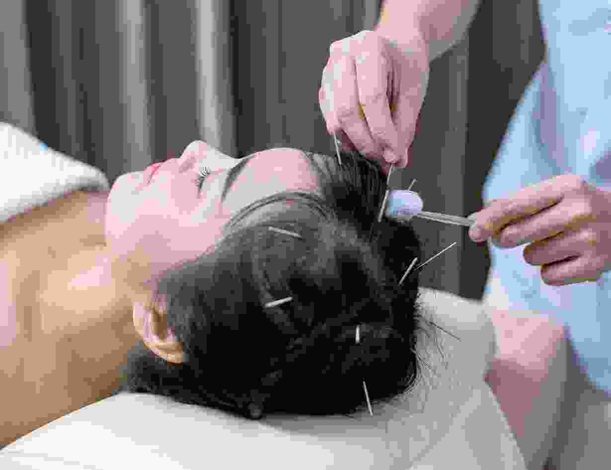 Androgenic alopecia - Beijing Acupuncture Center