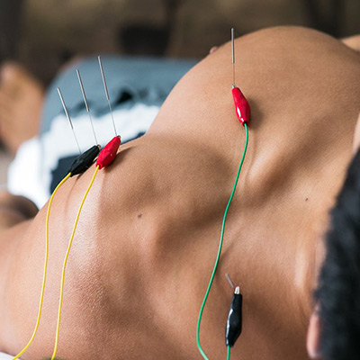 Electro Acupuncture Therapy