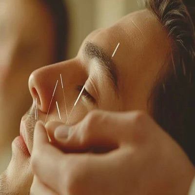 Face Acupuncture Therapy